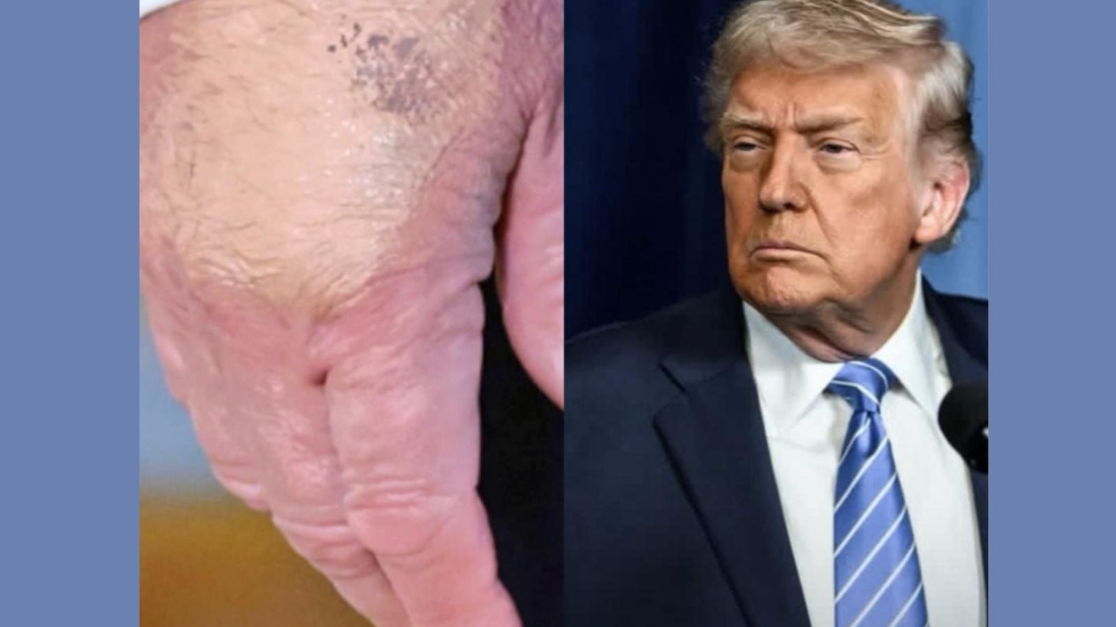 Trump's Weirdly Discolored Hands Are Trending Again and This Time the Left Hand Joined the Conversation